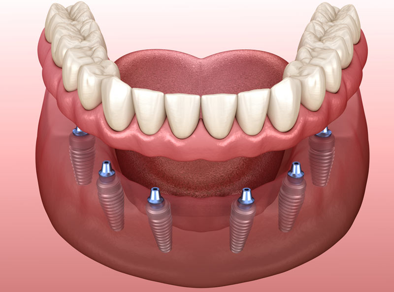 All-on-X Dental Implant Dentists Jackson Michigan
