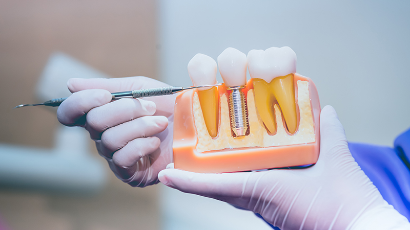 Dental implant care Jackson MI dentists