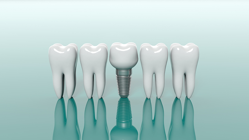 Dental implant dentists in Jackson MI